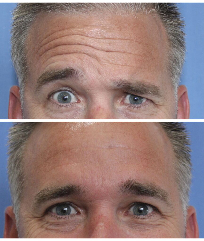 botox men forehead