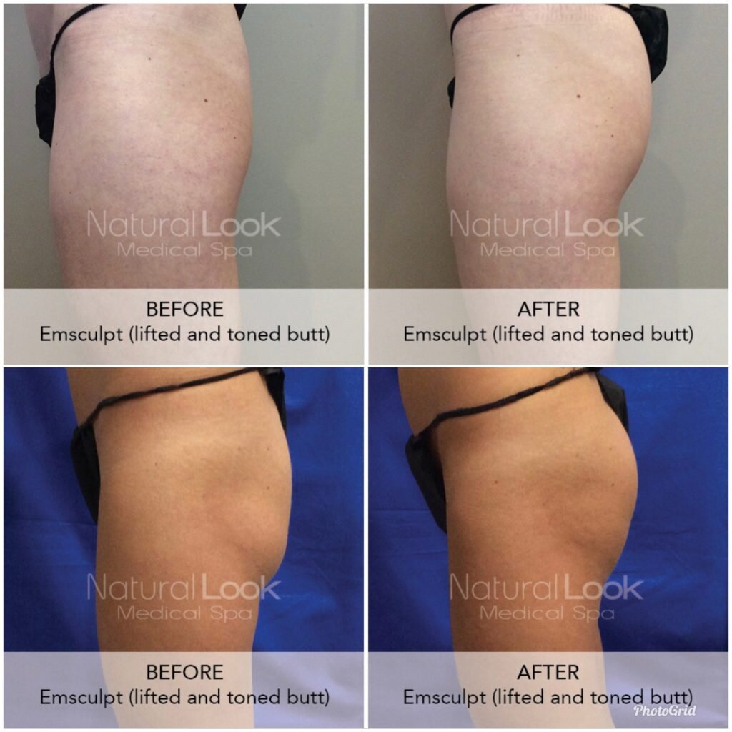 Butt Lifting Treatment by Emsculpt® Providers - Burn Fat & Build