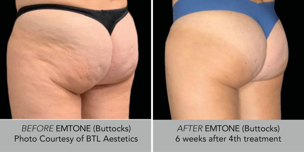 All About Cellulite Causes: Why Do I Have Cellulite?