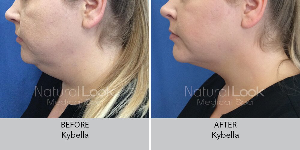 Kybella NaturalLookBeforeAfterphotos6