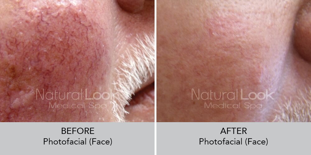 Photofacial NaturalLookBeforeAfterphotos2