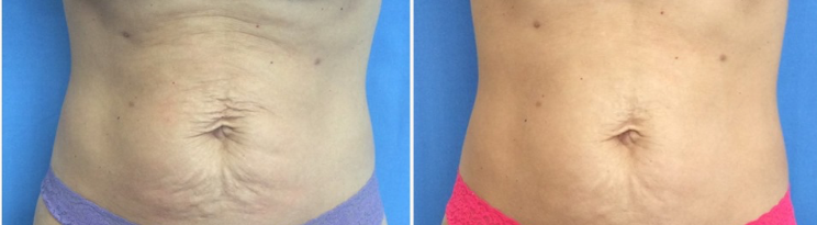 Fotona: TightSculpt Without Scars or Downtime