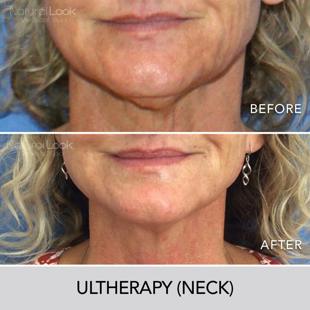 Ultatherapy NaturalLookBeforeAfter photo