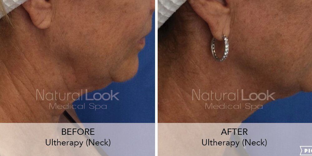 Microlift vs Thread Lift, Blog