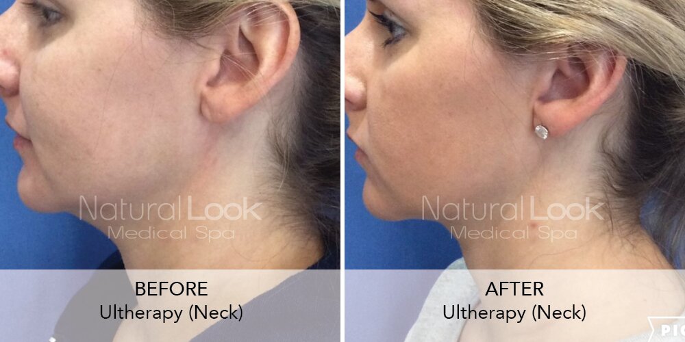 Microlift vs Thread Lift, Blog