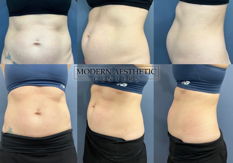 Body Contouring Gallery Before & After Image