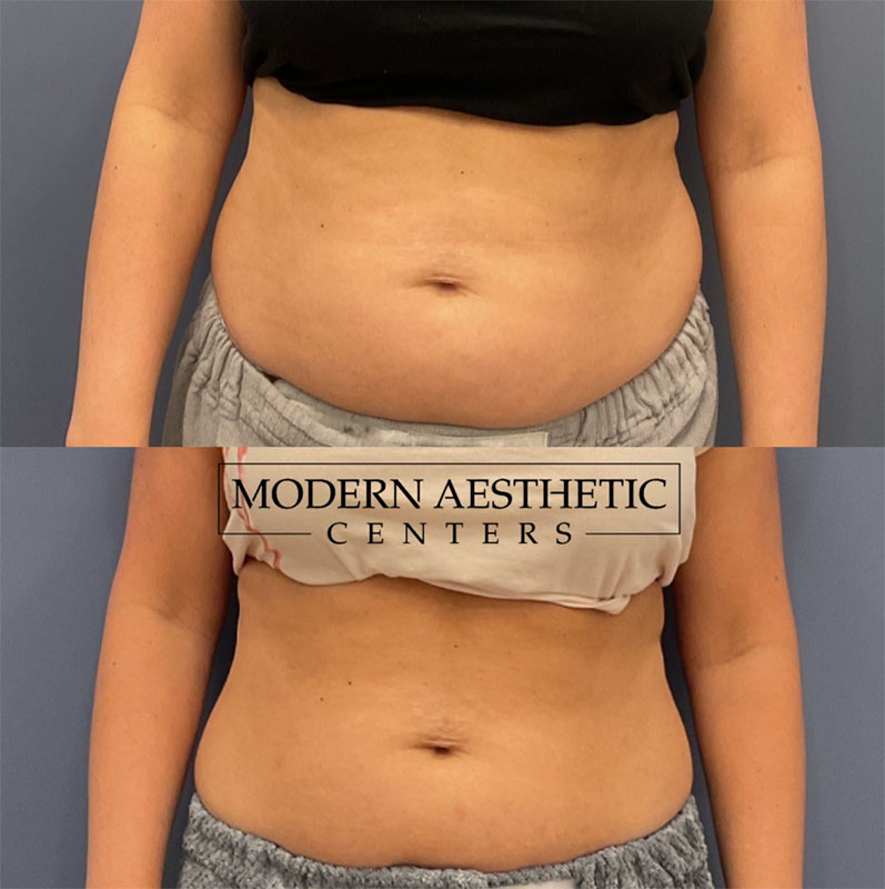 Body Contouring Gallery Before & After Image