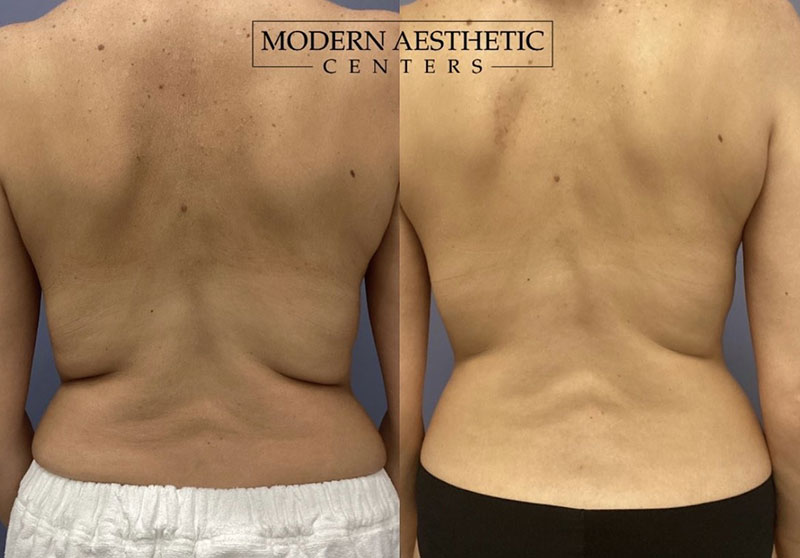 Body Contouring Gallery Before & After Image