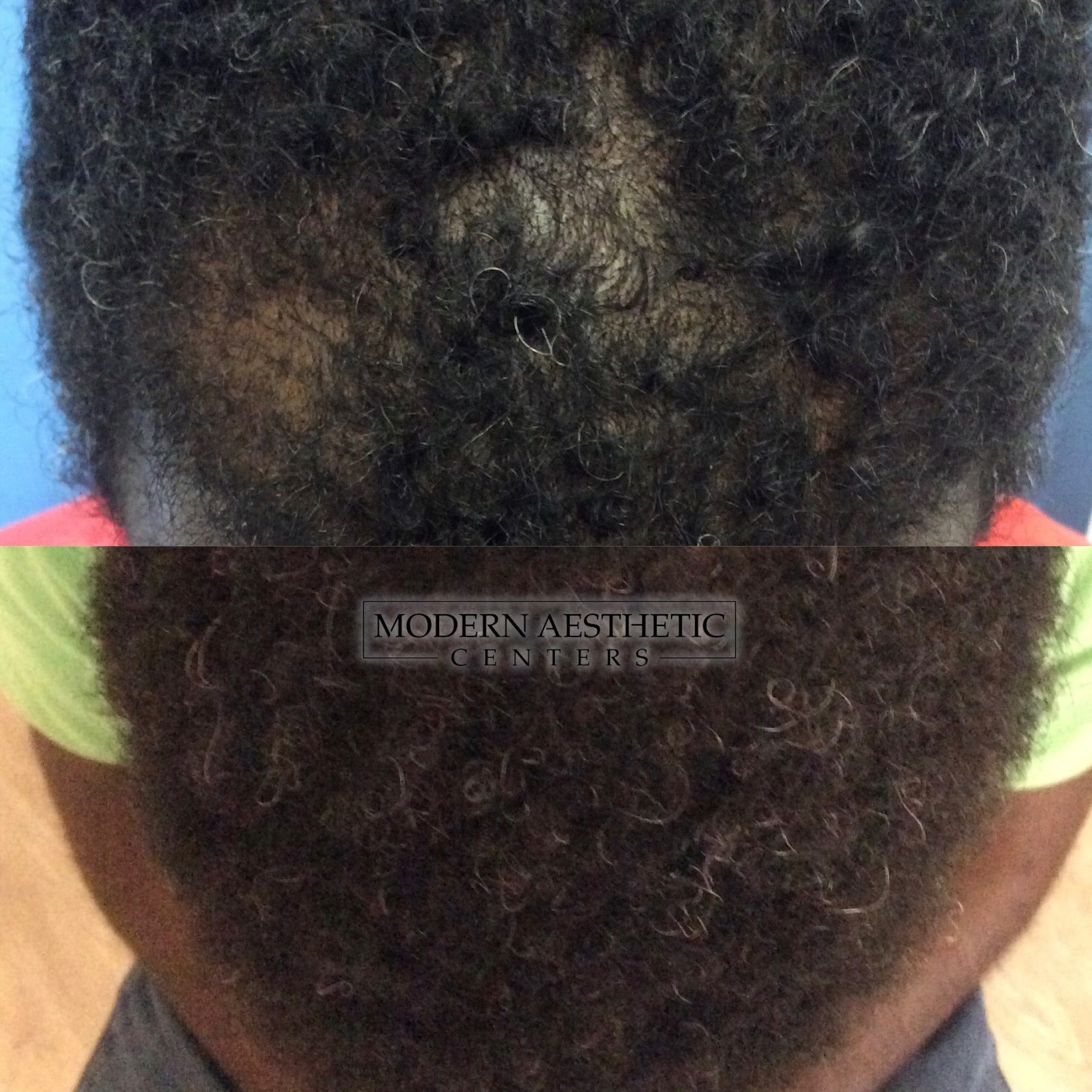 Hair Restoration Gallery Before & After Image