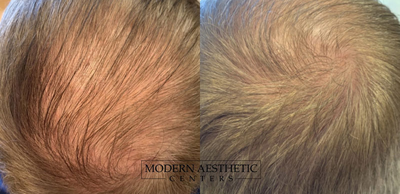 Hair Restoration Gallery Before & After Image