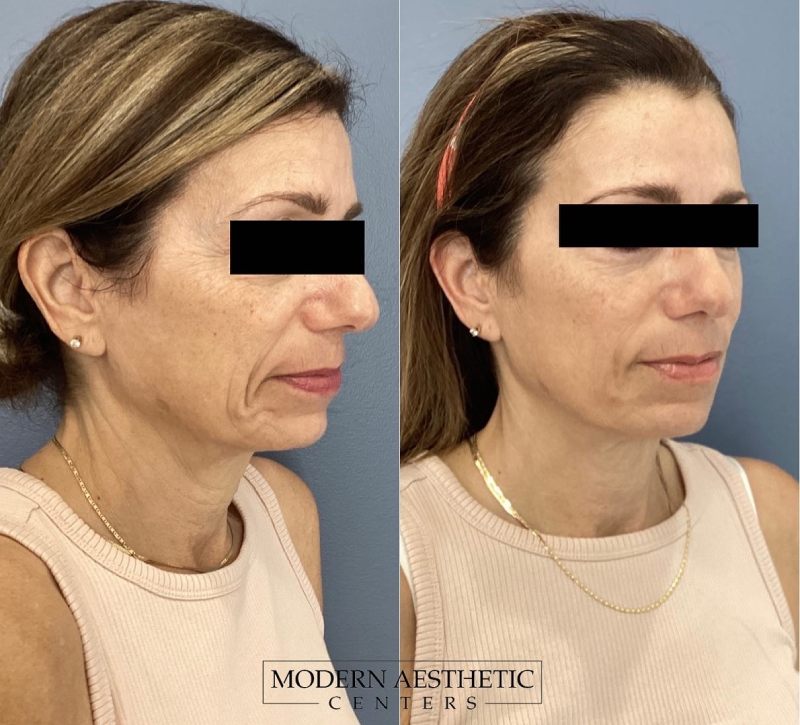 Dermal Fillers Gallery Before & After Image