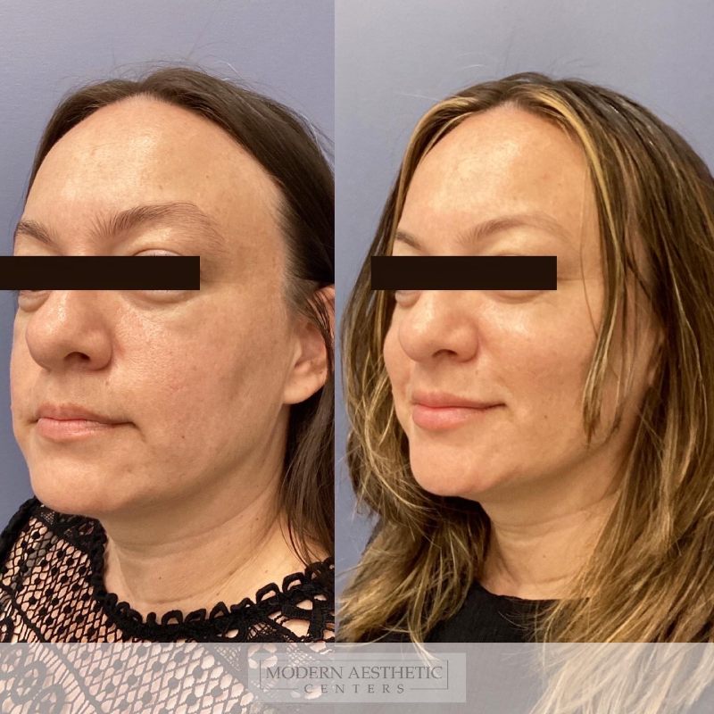 Dermal Fillers Gallery Before & After Image