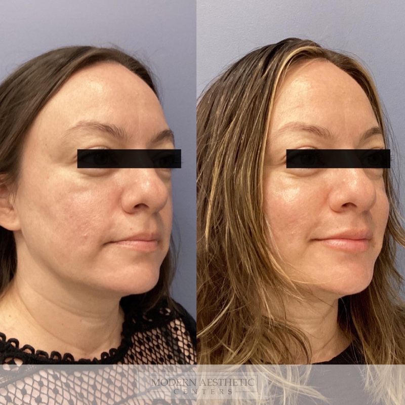 Dermal Fillers Gallery Before & After Image