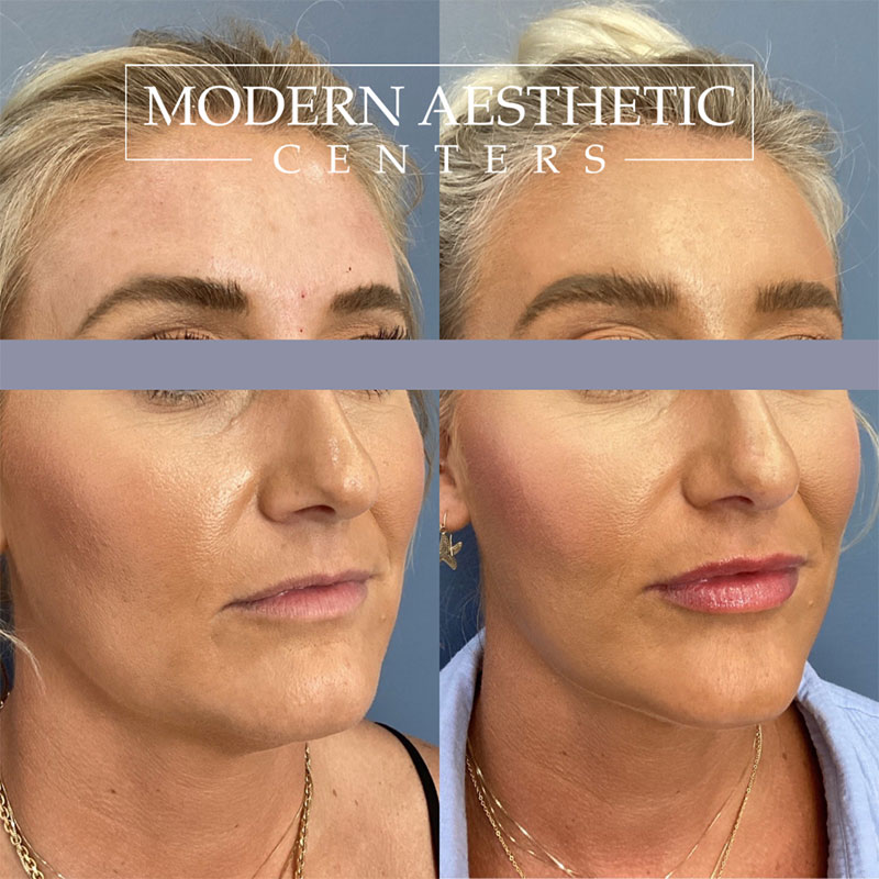 Dermal Fillers Gallery Before & After Image