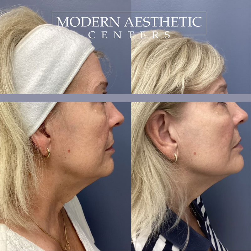 Dermal Fillers Gallery Before & After Image