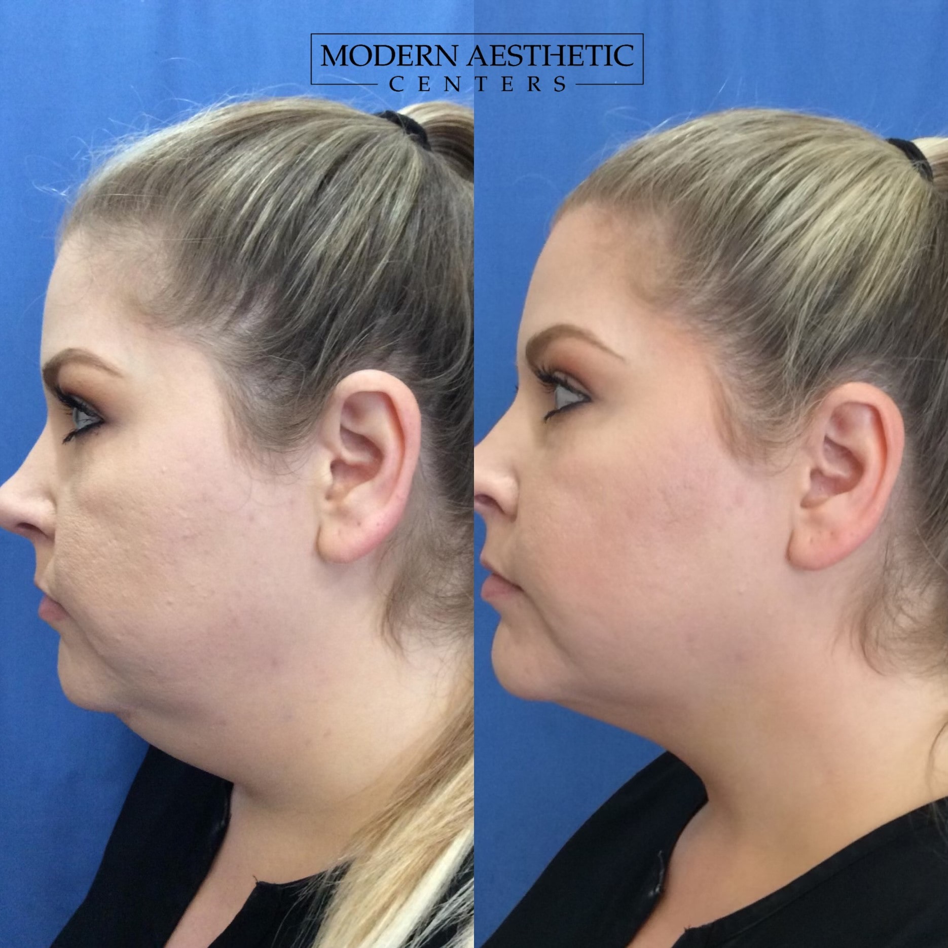 Kybella Gallery Before & After Image