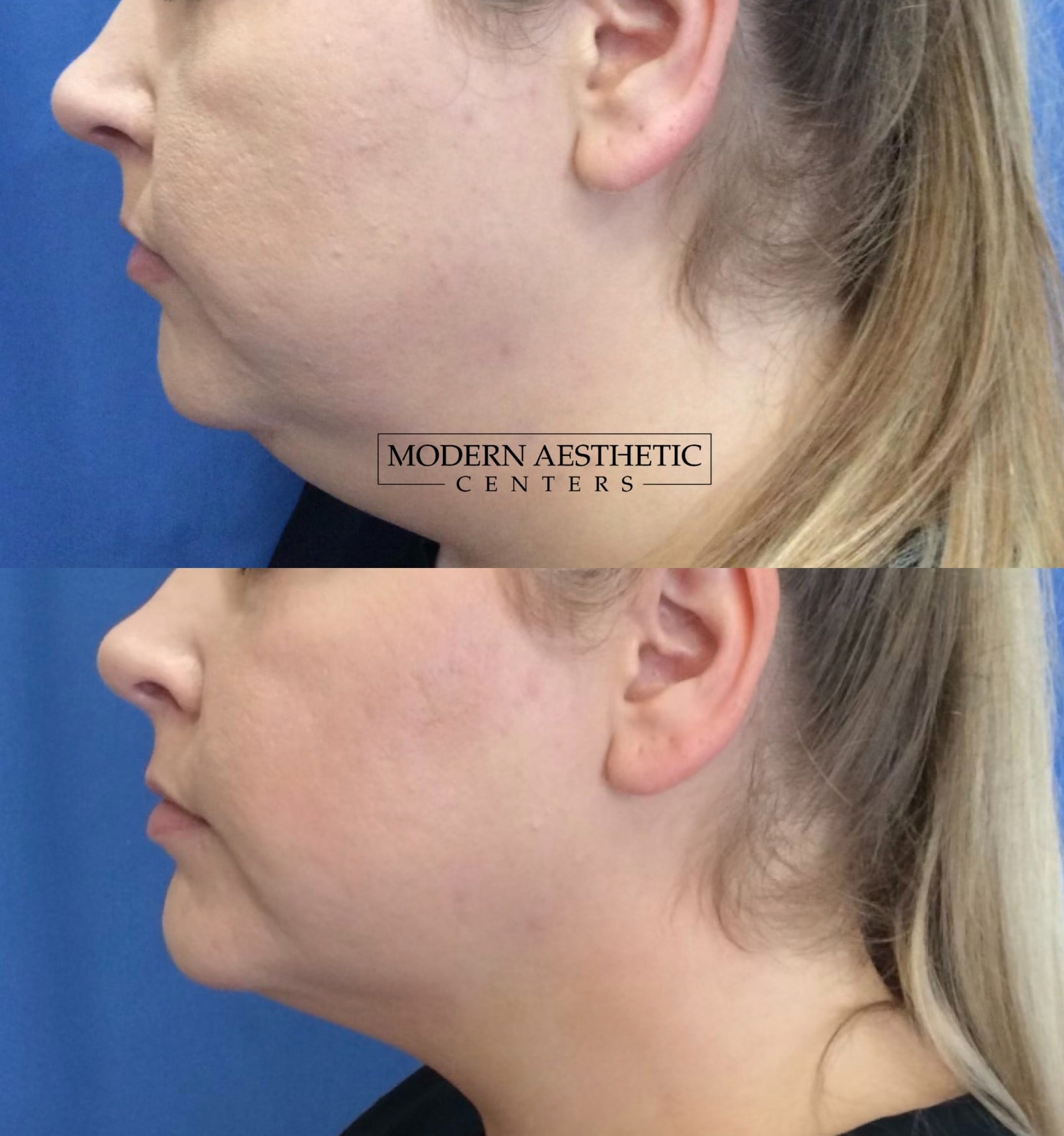 Kybella Gallery Before & After Image