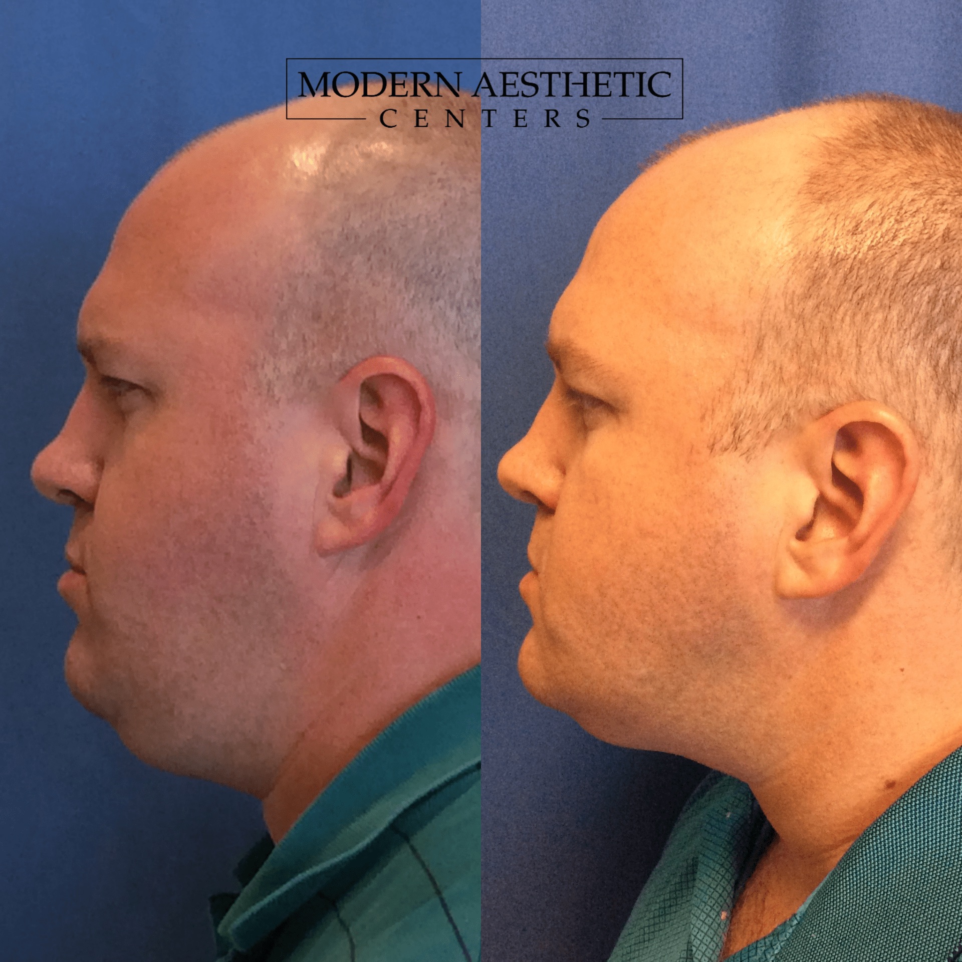 Kybella Gallery Before & After Image