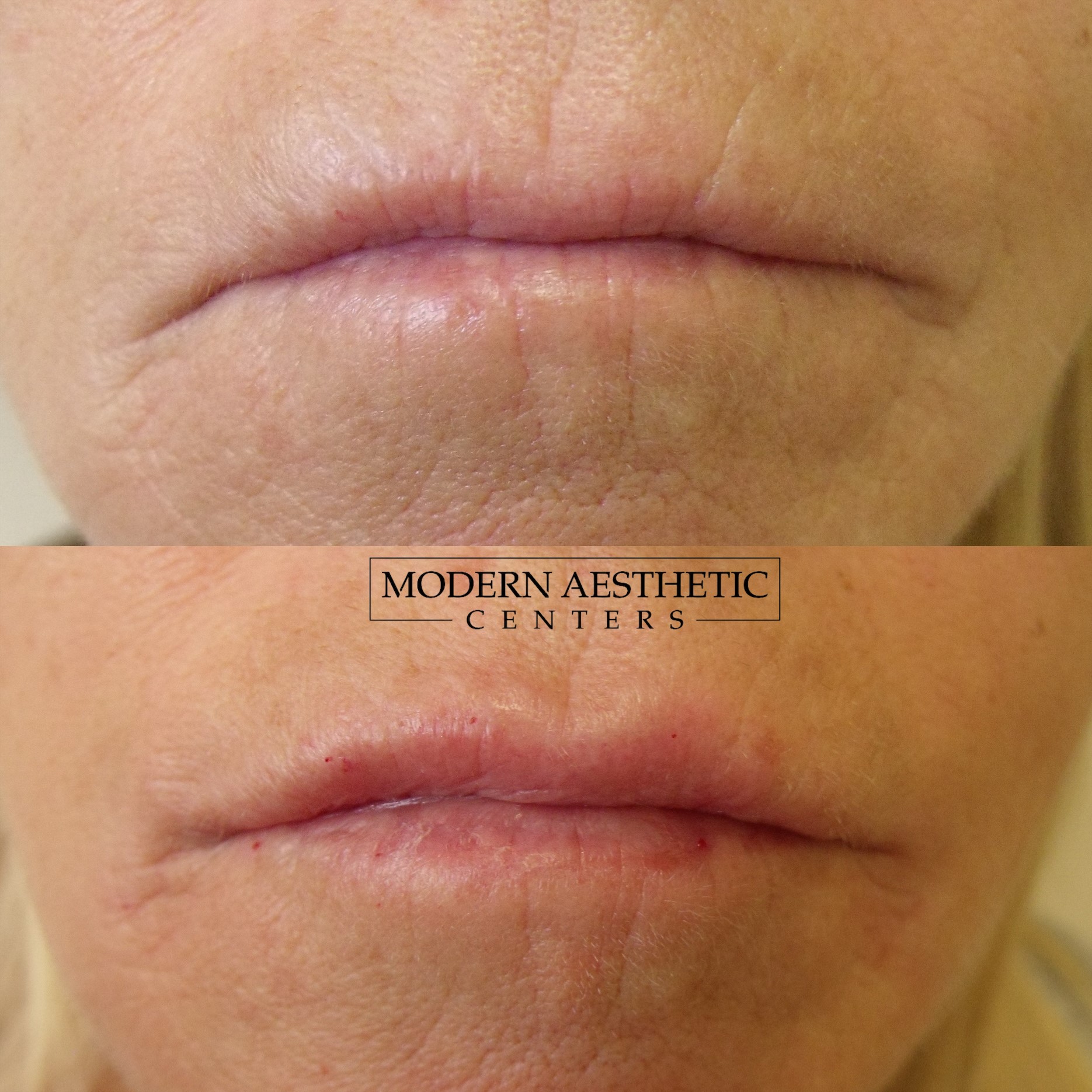 Lip Fillers Gallery Before & After Image