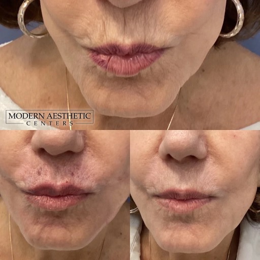 Lip Fillers Gallery Before & After Image