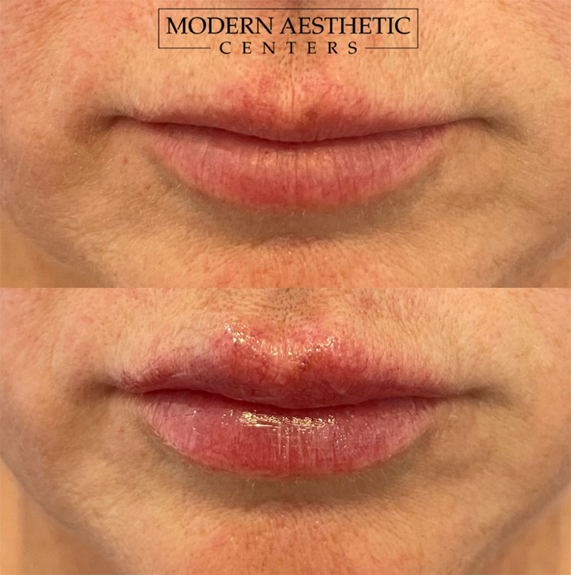 Lip Fillers Gallery Before & After Image