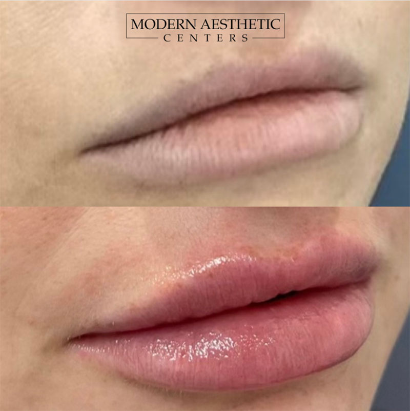 Lip Fillers Gallery Before & After Image