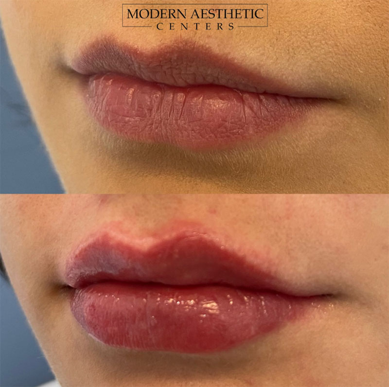 Lip Fillers Gallery Before & After Image