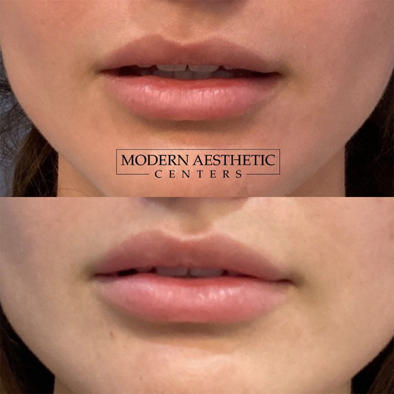 Lip Fillers Gallery Before & After Image