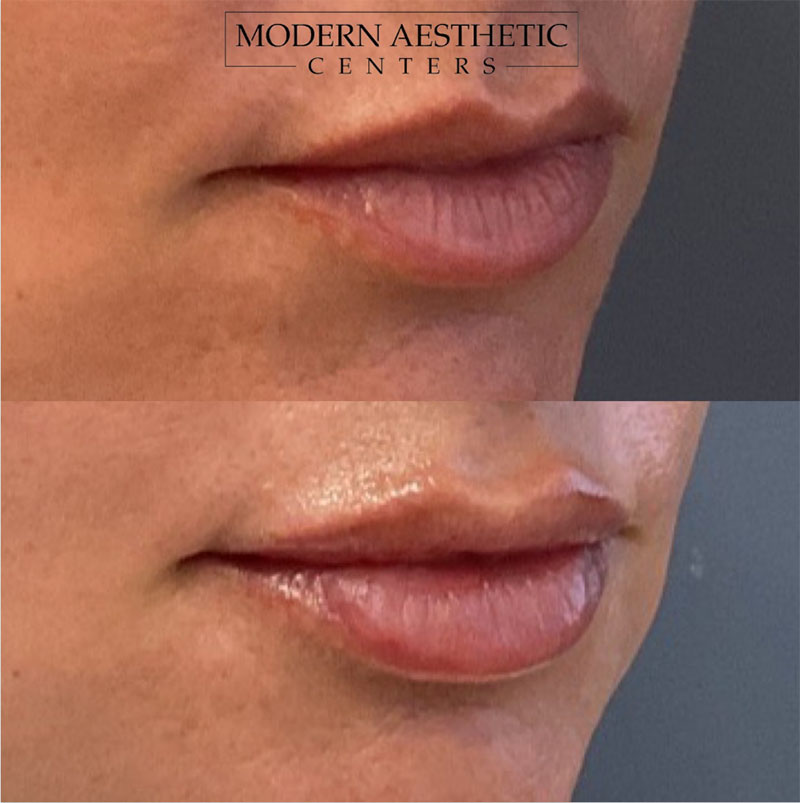 Lip Fillers Gallery Before & After Image