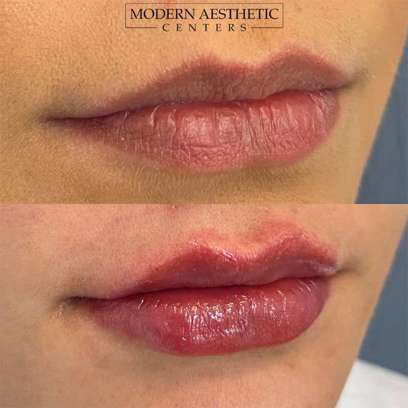 Lip Fillers Gallery Before & After Image