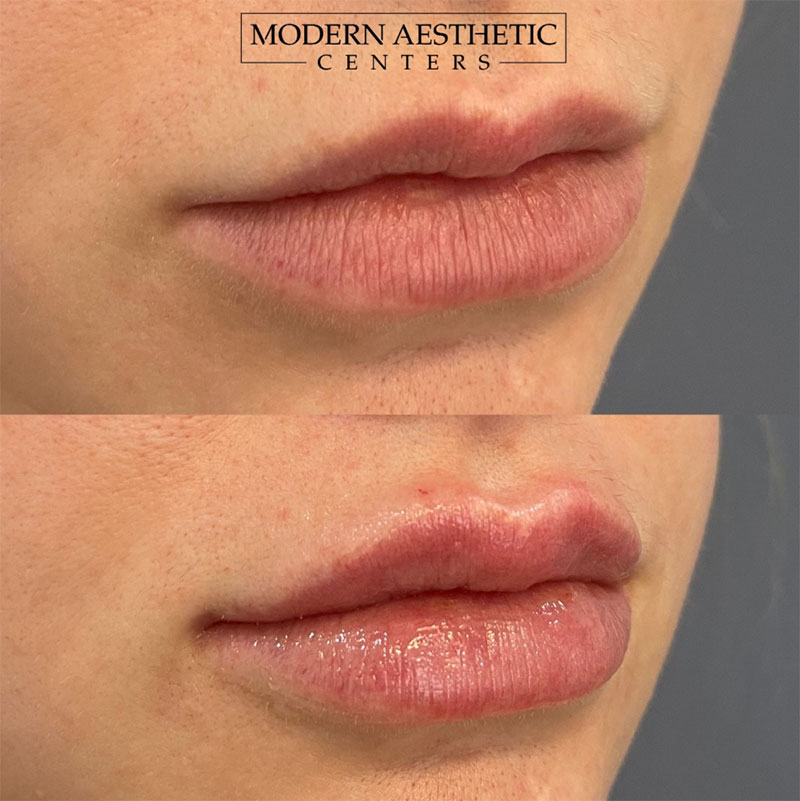 Lip Fillers Gallery Before & After Image