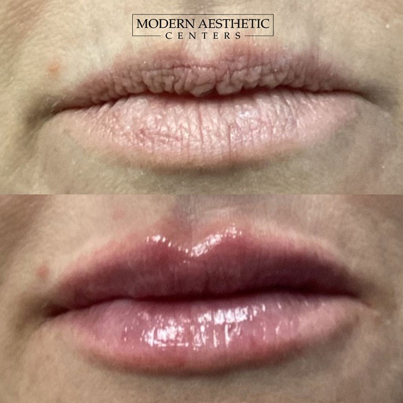 Lip Fillers Gallery Before & After Image