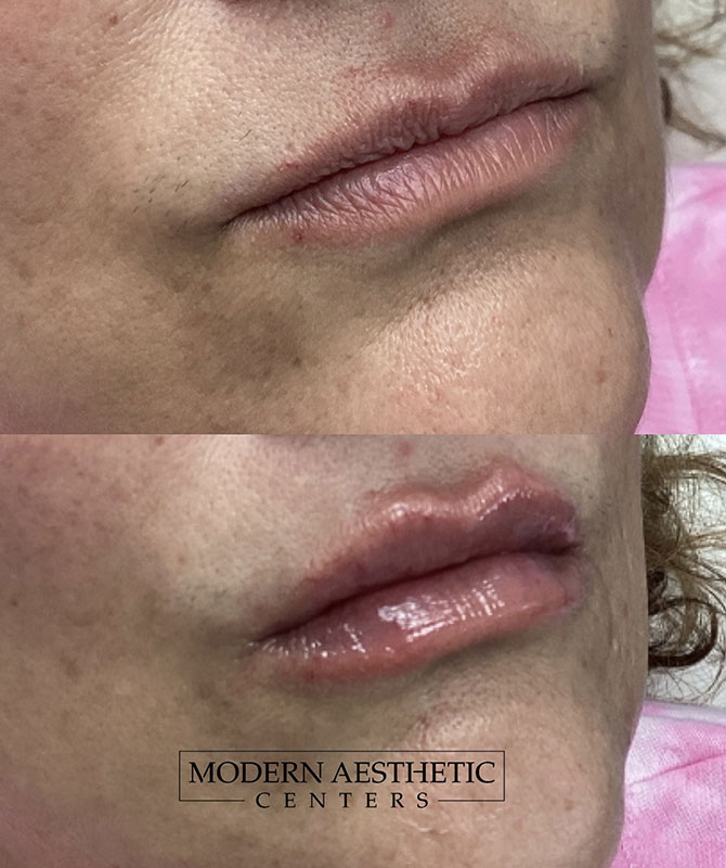 Lip Fillers Gallery Before & After Image