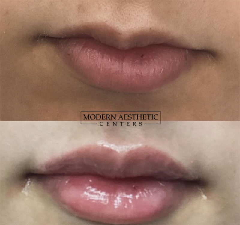 Lip Fillers Gallery Before & After Image