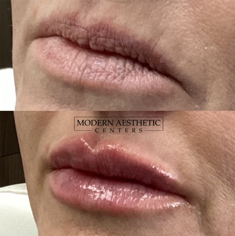 Lip Fillers Gallery Before & After Image