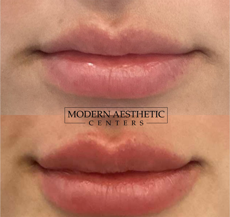 Lip Fillers Gallery Before & After Image