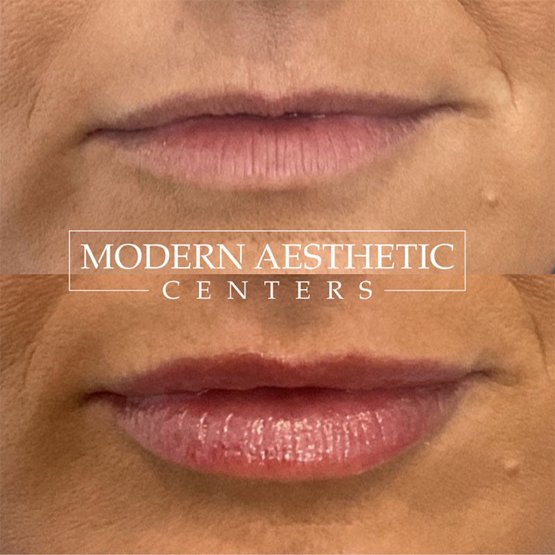 Lip Fillers Gallery Before & After Image