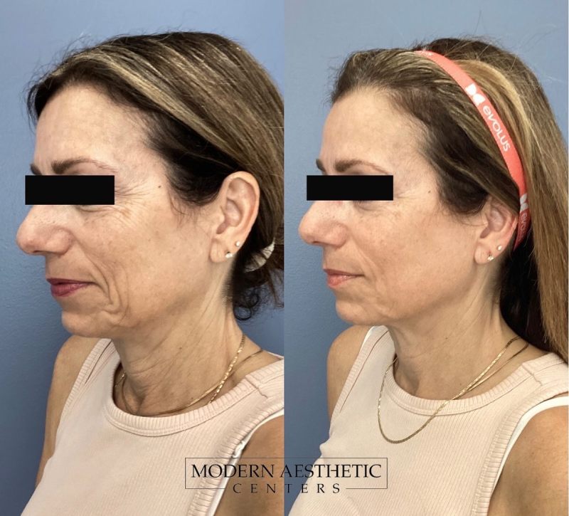 Wrinkle Relaxers Gallery Before & After Image