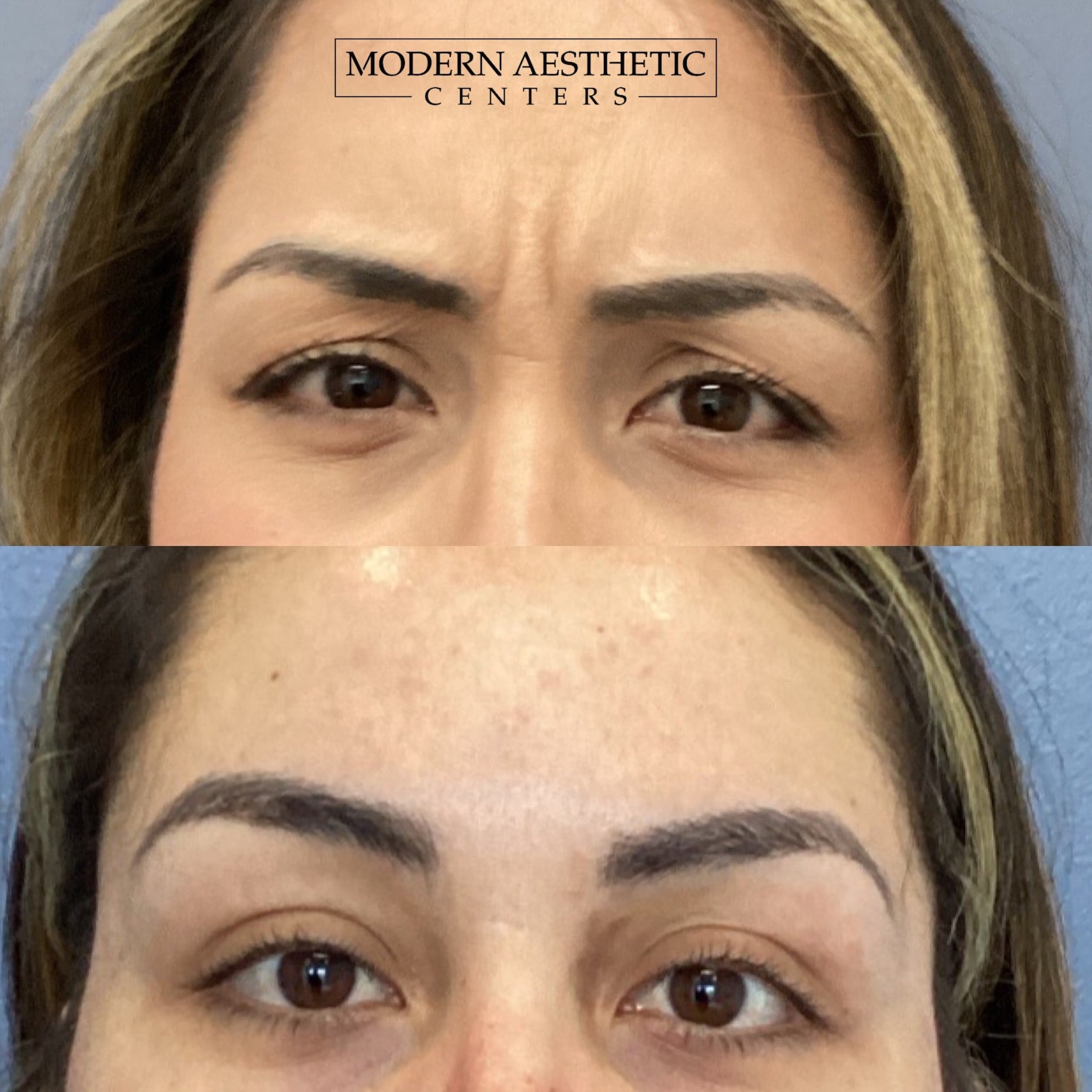 Wrinkle Relaxers Gallery Before & After Image