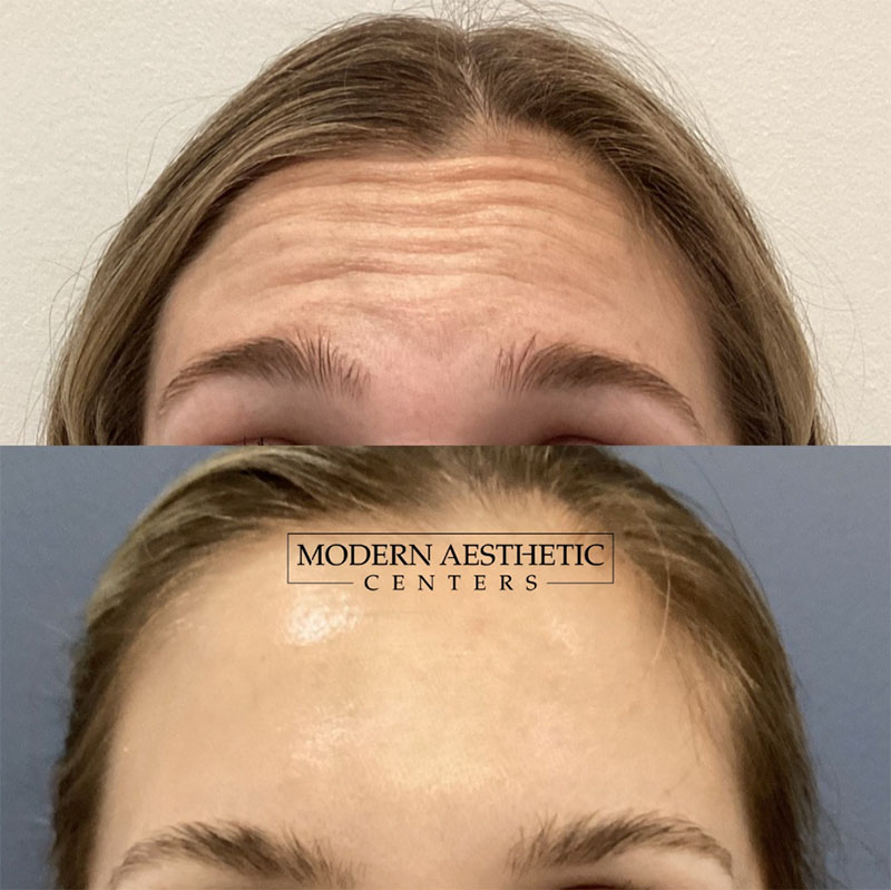 Wrinkle Relaxers Gallery Before & After Image