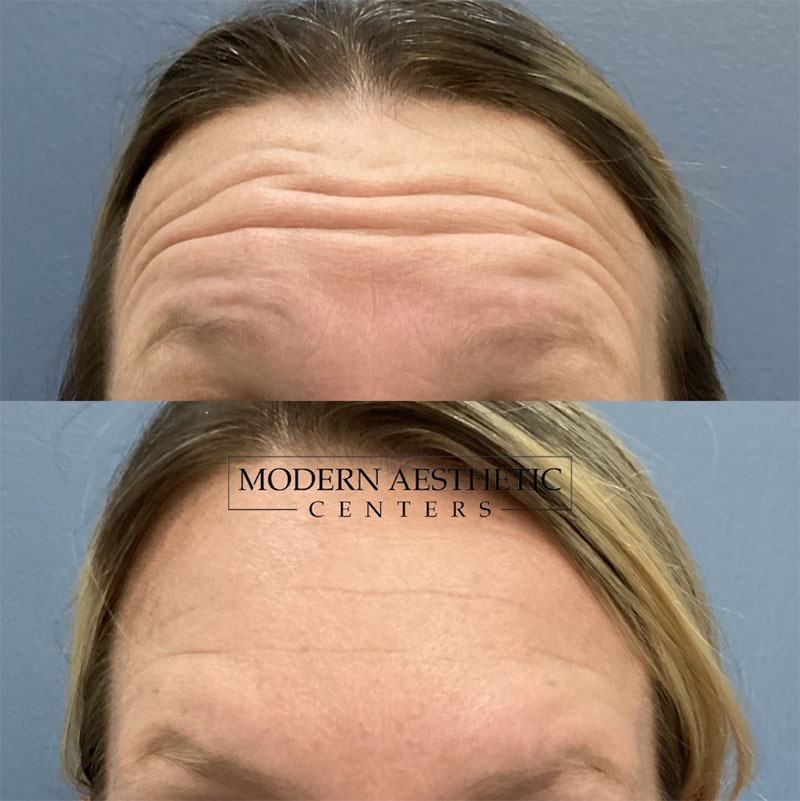 Wrinkle Relaxers Gallery Before & After Image