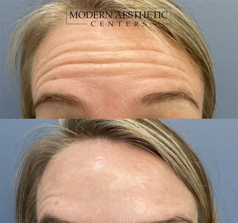 Wrinkle Relaxers Gallery Before & After Image