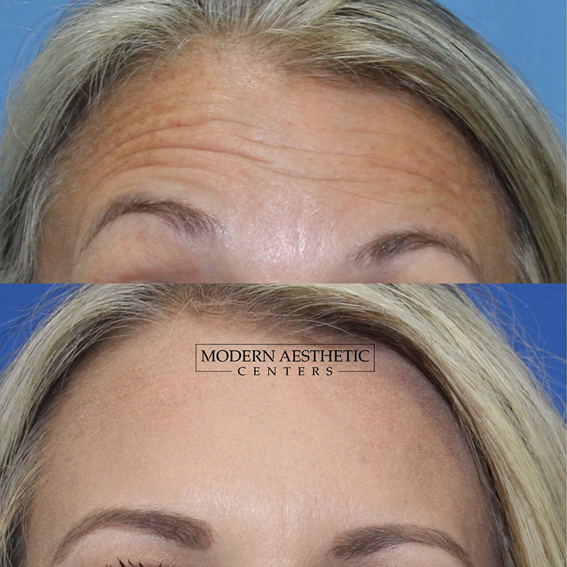 Wrinkle Relaxers Gallery Before & After Image