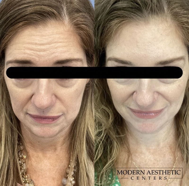 Wrinkle Relaxers Gallery Before & After Image