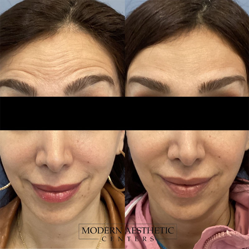 Wrinkle Relaxers Gallery Before & After Image