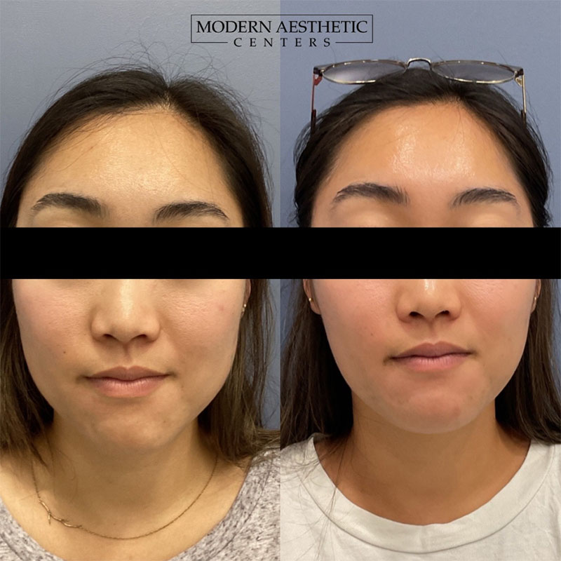 Wrinkle Relaxers Gallery Before & After Image