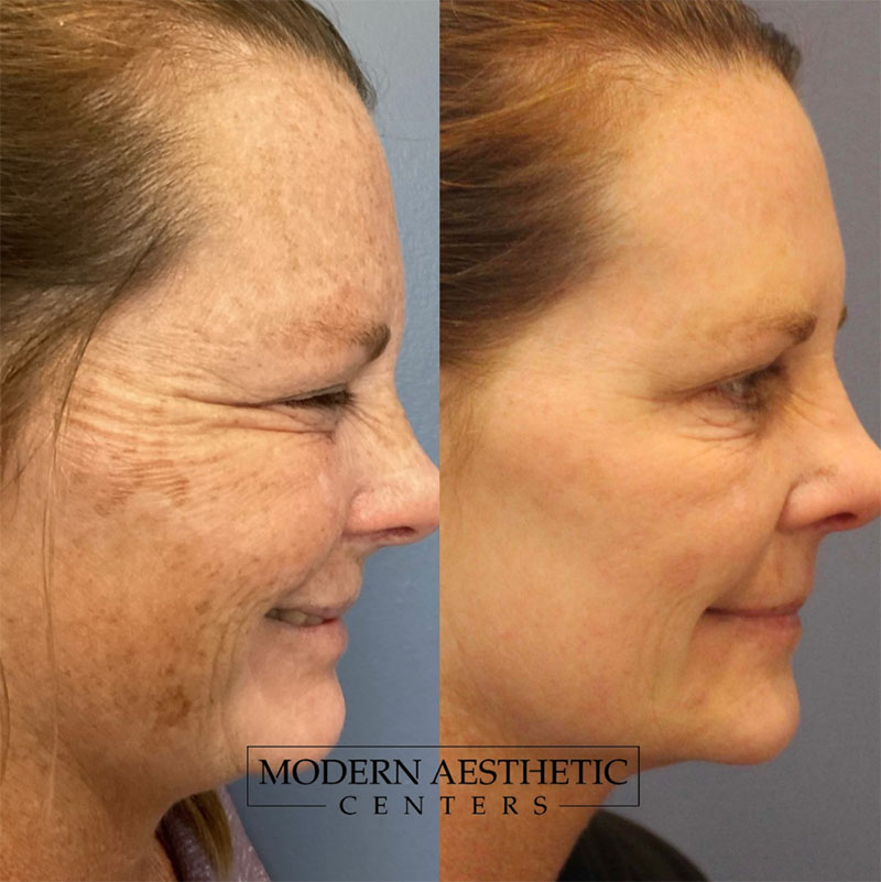 Wrinkle Relaxers Gallery Before & After Image