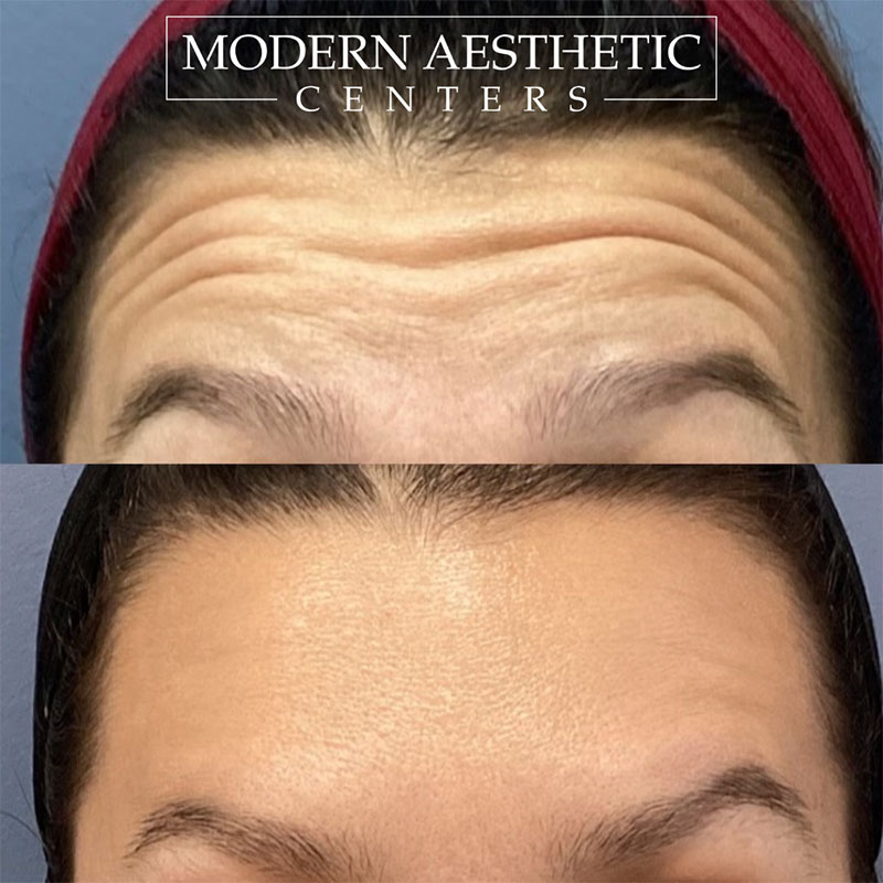 Wrinkle Relaxers Gallery Before & After Image