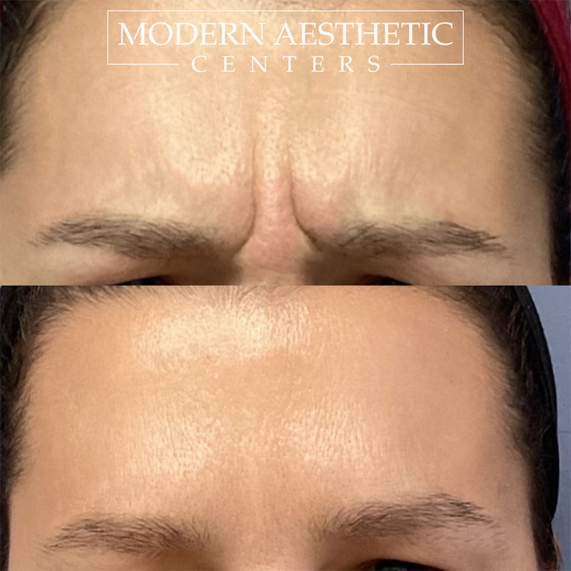 Wrinkle Relaxers Gallery Before & After Image