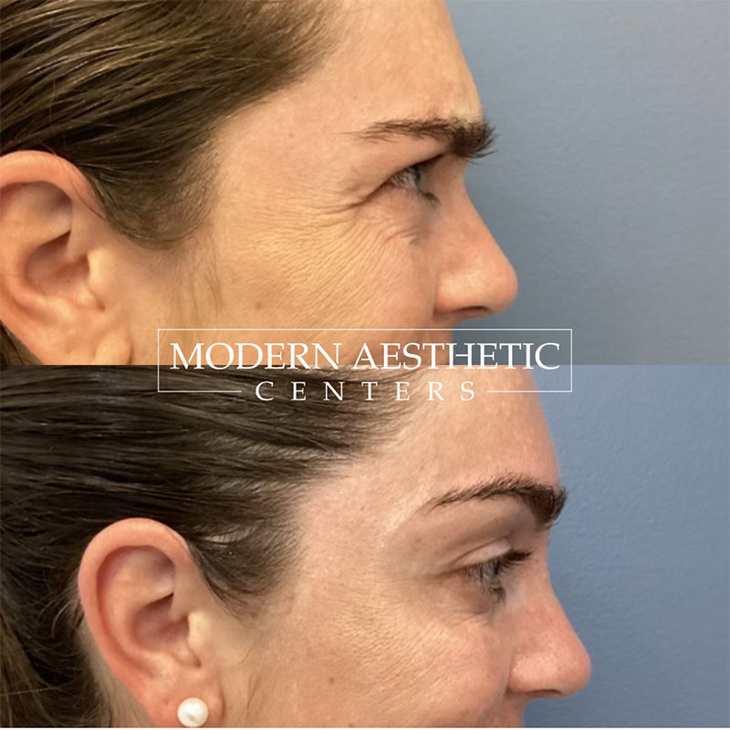 Wrinkle Relaxers Gallery Before & After Image